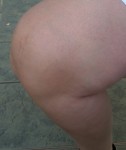 Arthrose- Knie